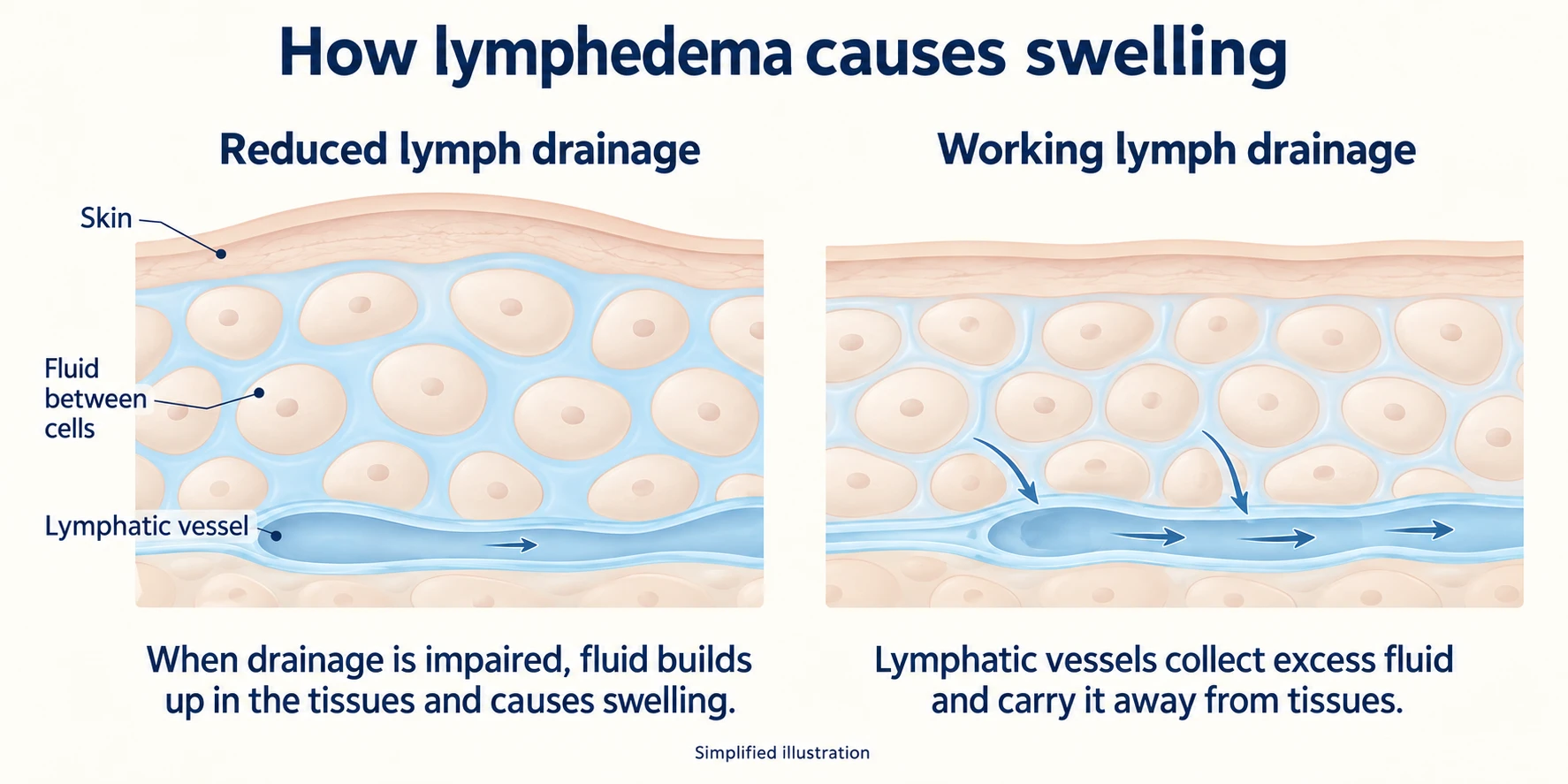 How lymphedema causes swelling. Left: with reduced lymph drainage, fluid builds up between the cells under the skin and causes swelling. Right: with working lymph drainage, lymphatic vessels collect the excess fluid and carry it away from the tissues.