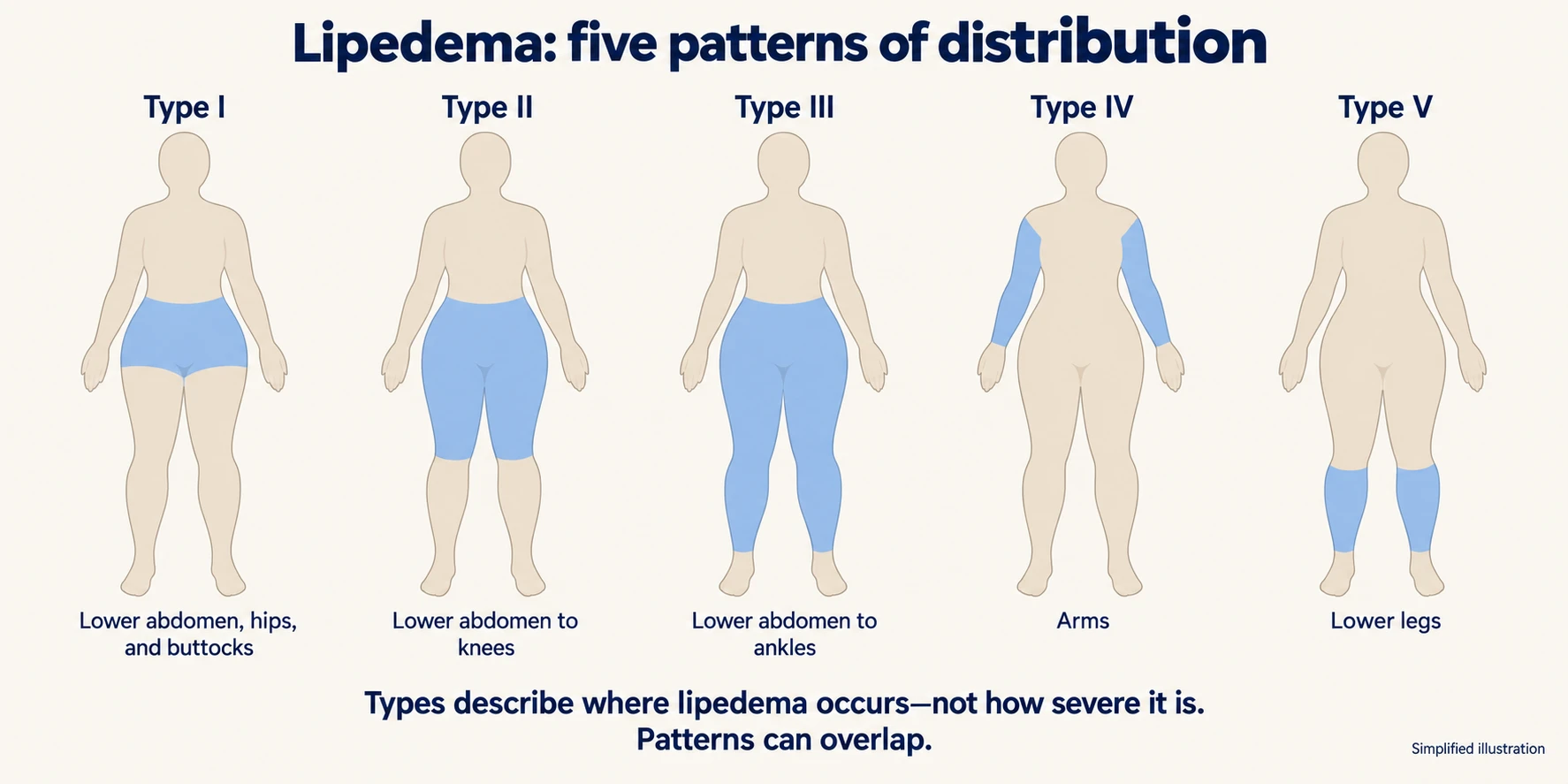 Lipedema: five patterns of distribution. Type I, lower abdomen, hips and buttocks. Type II, lower abdomen to the knees. Type III, lower abdomen to the ankles. Type IV, arms. Type V, lower legs. Types describe where lipedema occurs, not how severe it is, and patterns can overlap.
