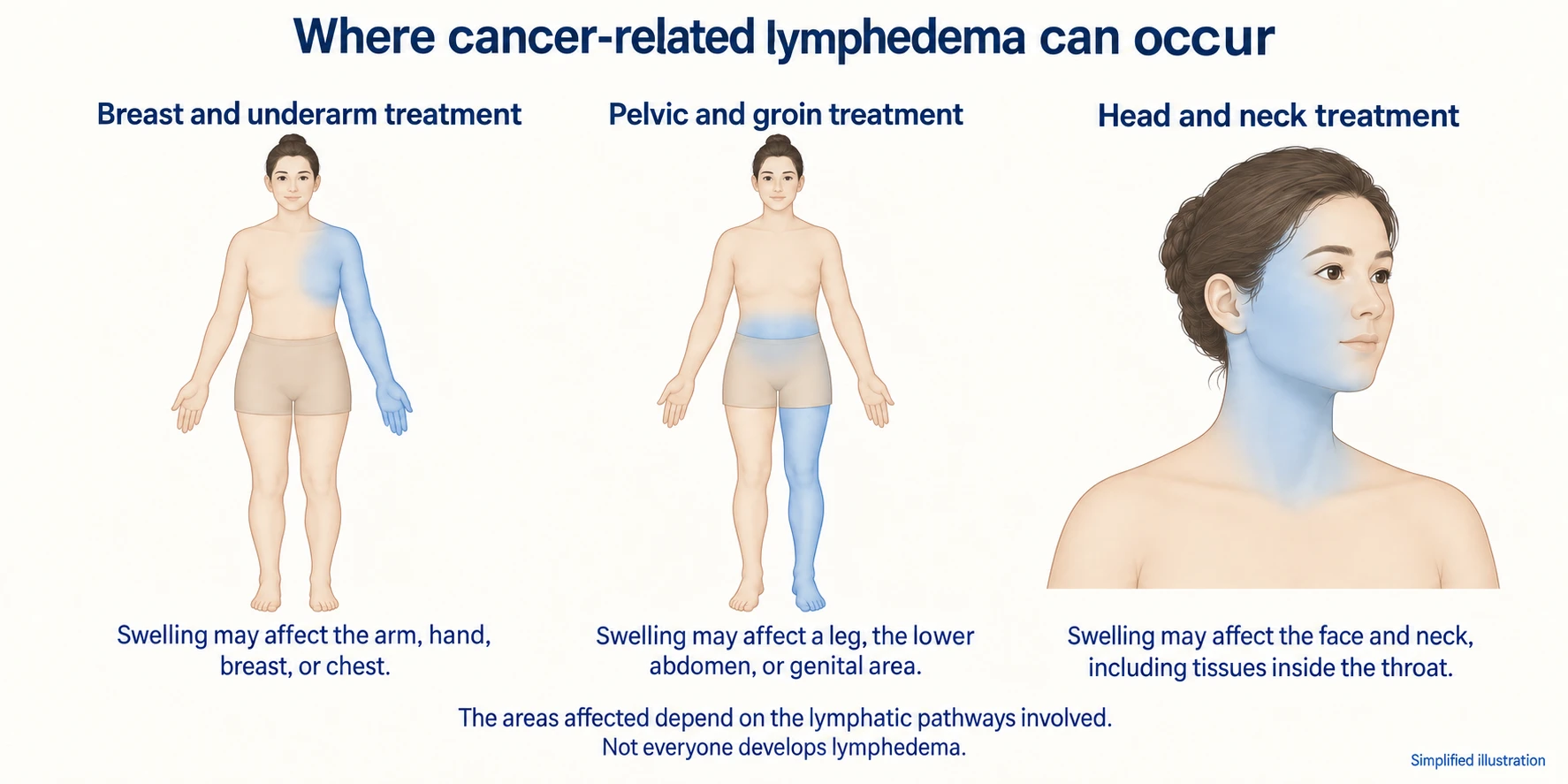 Where cancer-related lymphedema can occur. After breast and underarm treatment, swelling may affect the arm, hand, breast or chest. After pelvic and groin treatment, a leg, the lower abdomen or the genital area. After head and neck treatment, the face and neck, including tissues inside the throat. The areas affected depend on the lymphatic pathways involved; not everyone develops lymphedema.